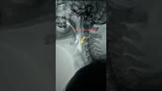 Movement of epiglottis in xray [upl. by Karna]