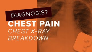 Chest XRay breakdown understanding mediastinal contour [upl. by Ecinrahs]