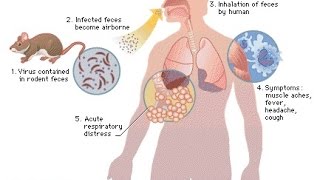 Hantavirus Treatment [upl. by Kristine526]