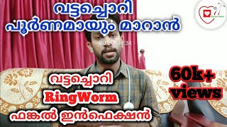 Tips for Fungal infection Malayalam  RingWorm Treatment Malayalam വട്ടച്ചൊറി മാറാൻ നാം ചെയ്യേണ്ടത് [upl. by Deutsch34]