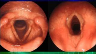 Hoarseness Explained Medical Course [upl. by Pownall707]