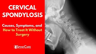 CERVICAL SPONDYLOSIS Causes Symptoms and Treatment NO SURGERY [upl. by Iphagenia]