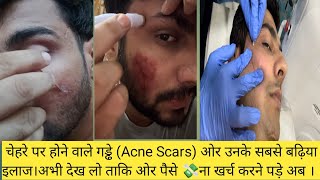 Acne Scars Types And Treatments । चेहरे के गड्ढो के प्रकार ओर उनके इलाज । HEALTHWITHBEAUTY [upl. by Anitac]