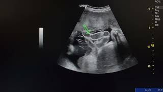 ultrasound case shows a fetus with gastroschisis [upl. by Ado]