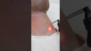 Hair removal at laserAway haircare [upl. by Donoho715]