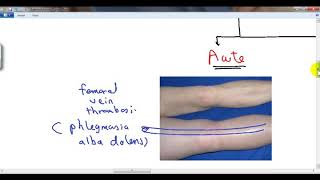 GENERAL PATHOLOGY 40  hyperaemia and oedema DR SAMEH GHAZY [upl. by Prue]