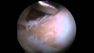 Hip Arthroscopy Chondroplasty and Osteoplasty of CAM Lesion [upl. by Aisiram918]