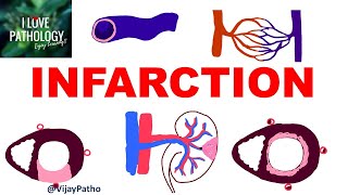 INFARCTION Causes Types Morphology [upl. by Felita]