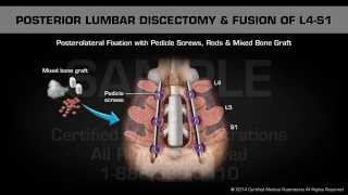 Posterior Lumbar Discectomy amp Fusion of L4S1 [upl. by Larrisa]