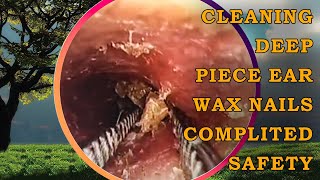 Cleaning Deep Piece Ear Wax Nails Complited Safety  Ear Wax Removal [upl. by Binni49]