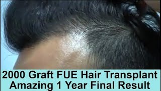 37 Year Old Norwood 3 Pattern 2000 Graft FUE Hair Transplant 1 Year Final Result [upl. by Amaso]