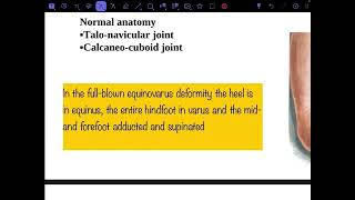 Congenital talipes equinovarus part 1 [upl. by Rogerio]