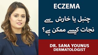 ChambalKharish Ka llaj  Eczema Ka Ilaj  How To Treat Eczema  Eczema Treatment  Dr Sana Younas [upl. by Ehtiaf]