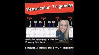 Ventricular Trigeminy  EMS Cardiology [upl. by Nayr]