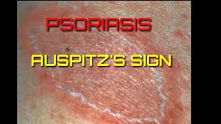 Auspitzs sign demonstrationGrattage testpsoriasis [upl. by Hardwick]