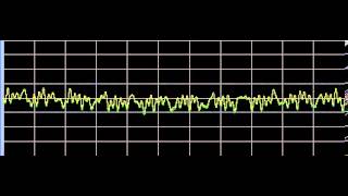 Raynauds Disease  Rife Frequencies [upl. by Elyod6]