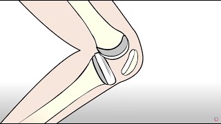 Knee Replacement vs Regenexx Orthopedic Regenerative Treatment [upl. by Onurb]