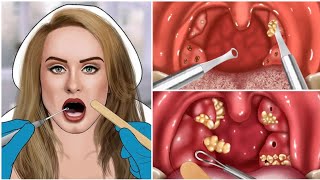 ASMR Remove The Tonsil Stone  Tonsil Stone Removal Animation ASMR Treatment [upl. by Dickey705]