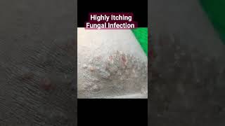 Highly Itching Fungal Infection  Ringworm of Groin  Tinea cruris [upl. by Adali]