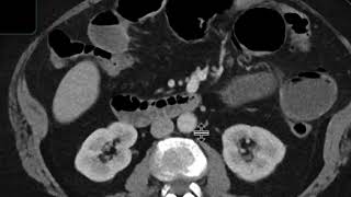 Gallstone ileus [upl. by Willmert669]