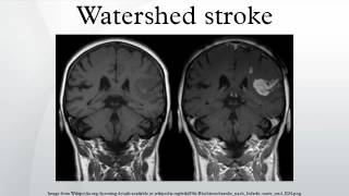 Watershed stroke [upl. by Aihsekram397]