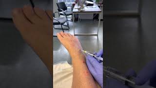 Lyftogt perineural injection therapy for entrapment superficial peroneal dorsal cutaneous nerve [upl. by Desireah]