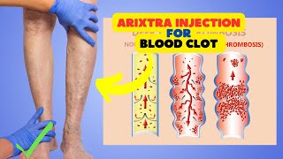 Arixtra Injection for Blood Clot Prevention Common Uses and Benefits [upl. by Herald]