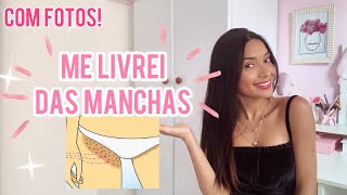 COMO TER UMA VIRILHA LISINHA SEM MANCHAS ANTES E DEPOIS COM FOTOS [upl. by Elleyoj]