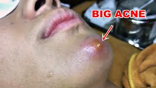 BIG ACNE ON CHIN [upl. by Candace]