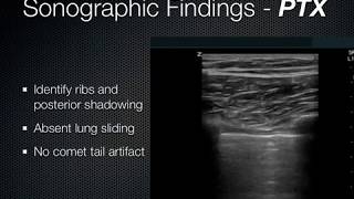 Lung Ultrasound EFFUSIONCONSOLIDATION [upl. by Reger]