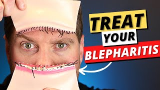 Blepharitis Top 3 Treatments For Blepharitis Removal At Home [upl. by Chimene924]