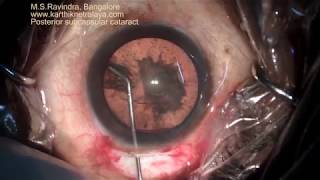 Posterior subcapsular cataract and hydrodissection in Cataract IOL surgery [upl. by Citron]