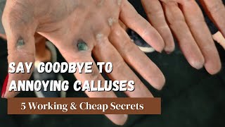 Calluses Removal  5 Simple and Effective Techniques [upl. by Akemot]