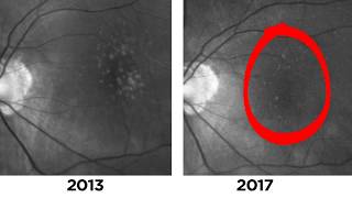 Two Cases of Disappearing Drusen in Patients with AMD [upl. by Hussein958]