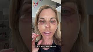 My Advanced Facelift Recovery Day by Day  Real Stories By Real Patients 2022 [upl. by Cates]