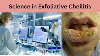 Exploring the Science of Exfoliative Cheilitis Unraveling the Mysteries [upl. by Norma]