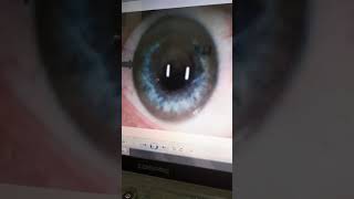 ترسب النحاس داء ويلسونspot diagnosis [upl. by Rodge]