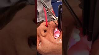 Tips for Nasal Intubation [upl. by Anelagna704]