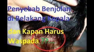 Penyebab Benjolan di Belakang Kepala dan Kapan Harus Waspada [upl. by Ma]