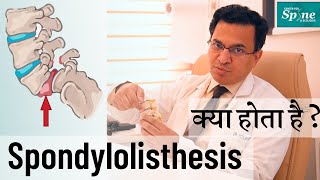 Spondylolisthesis क्या होता है  What is Spondylolisthesis Complete Info in Hindi [upl. by Debee50]