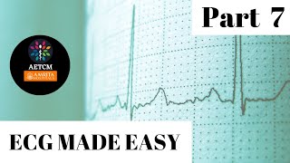 ECG Made Easy  Part 7  SVT vs VT [upl. by Willabella]