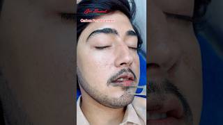 Carbon Peel Laser Treatment getsmarthairclub viralvideo beauty laserhairtreatment laser [upl. by Taffy]