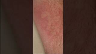 What do bed bug bites look like [upl. by Moneta695]