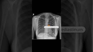 Pneumomediastinum and subcutaneous emphysema [upl. by Pontus]