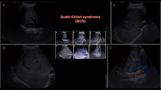 BuddChiari syndrome BCS [upl. by Eidurt761]