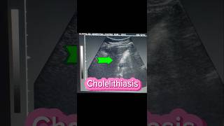 Stones in GB  Cholelithiasis  Cholecystitis  Gallstones  Fatty liver on Ultrasound [upl. by Candis]