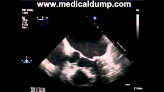 Left Atrial Appendage Thrombus  TransEsophageal Echocardiogram TEE [upl. by Rahr]