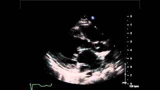 Coronary Sinus Atrial Septal Defect Parastermal Long Axis View with Dilated Coronary Sinus [upl. by Nevai598]