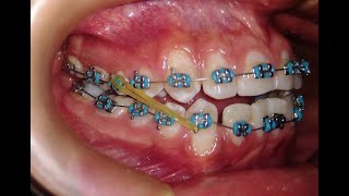 Elásticos Intermaxilares  Mira como ayudan en tu tratamiento con brackets☝ [upl. by Yrrek853]