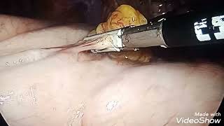 Laparoscopic Nissen fundoplication for Hiatal Hernia with GERD Za Abuja [upl. by Aihsenod22]